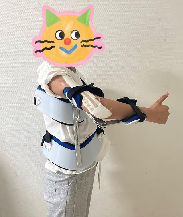 13歲少女患骨肉瘤面臨截肢，3D打印肱骨假體治療成功保肢